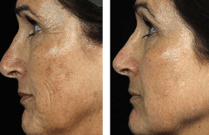 Vor und nach fraktionierter Gesichtsverjüngung