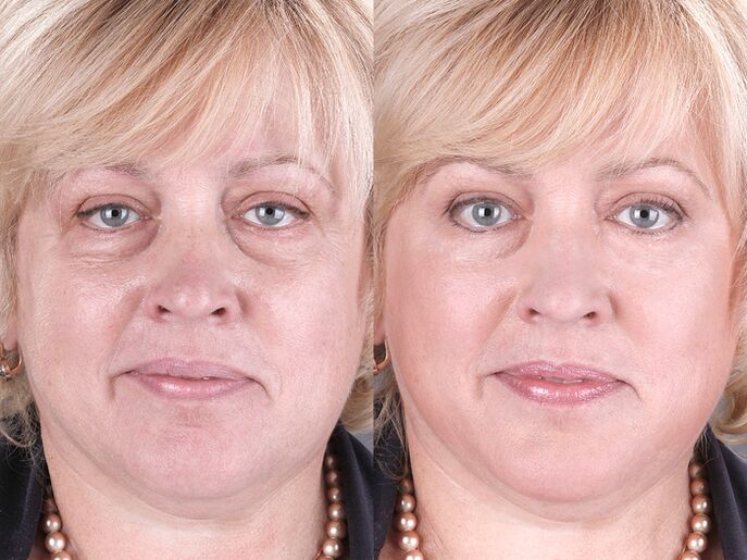vor und nach der Verwendung des Massagegeräts zur Verjüngung ltza Foto 3