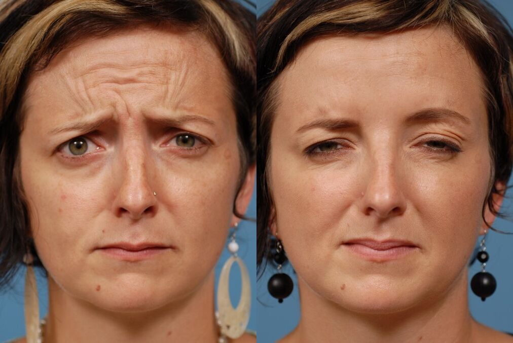 vor und nach der Verwendung des Massagegeräts zur Verjüngung ltza photo 2