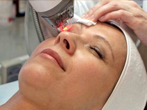 Laserverjüngung der Haut um die Augen
