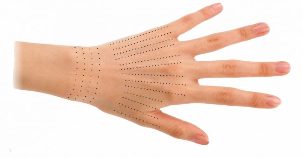 Injektionsstellen für Hände während der Biorevitalisierung